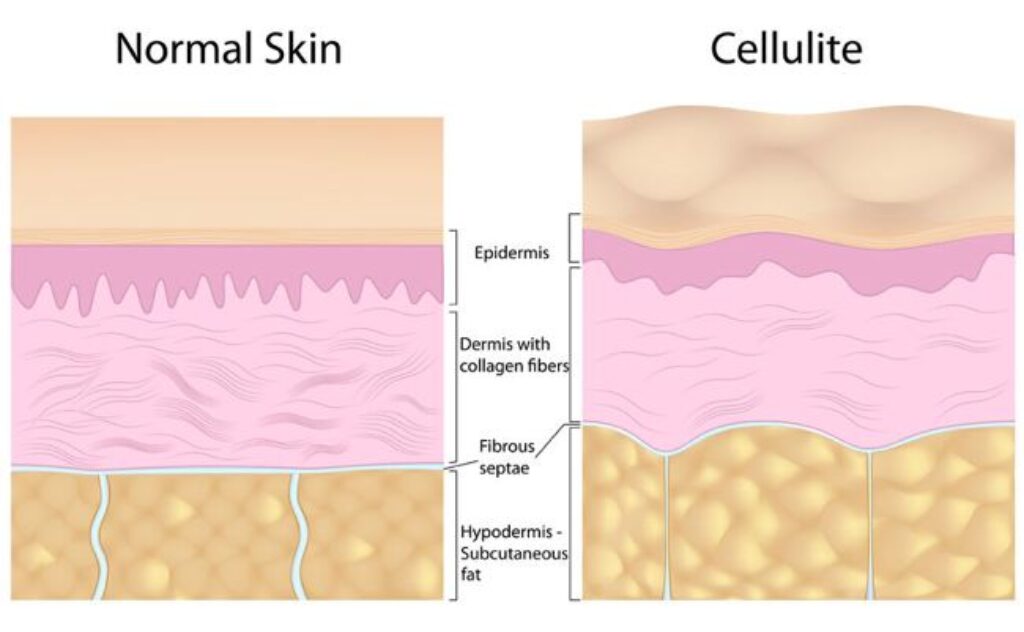 normal skin vs cellulite