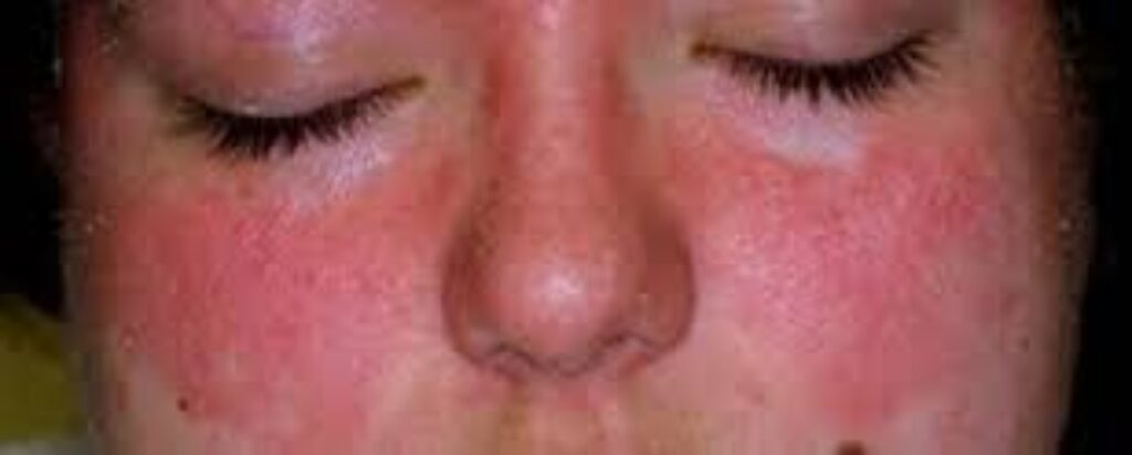 best treatment for seborrheic dermatitis on face