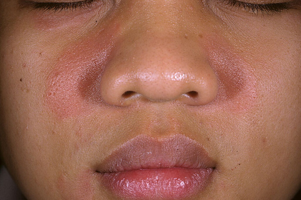 best treatment for seborrheic dermatitis on face