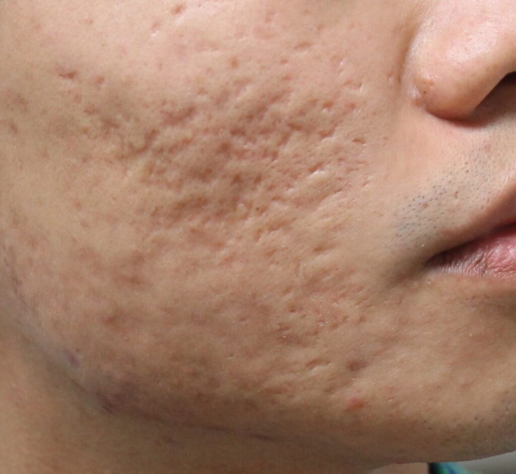 how to get rid of acne scars in 3 weeks