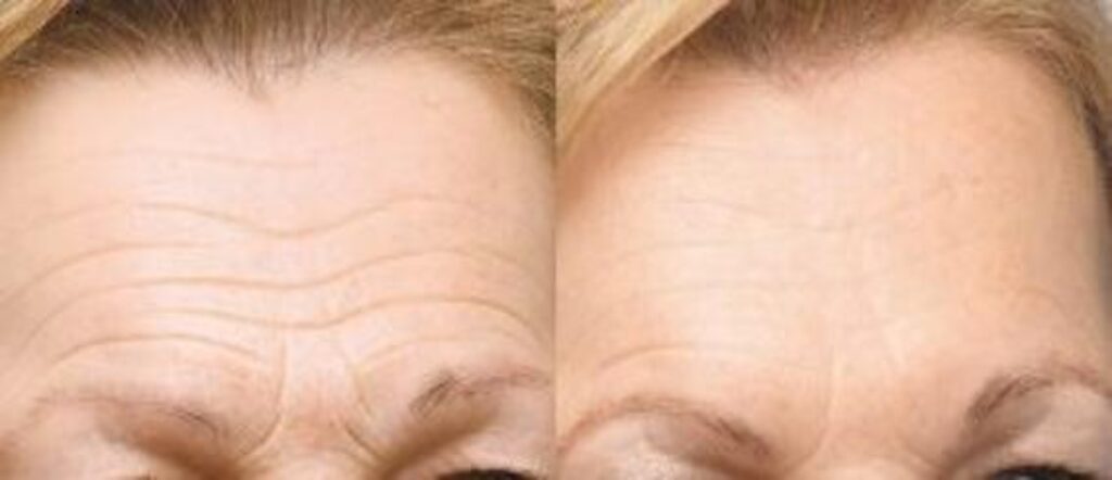 how to reduce wrinkles on forehead