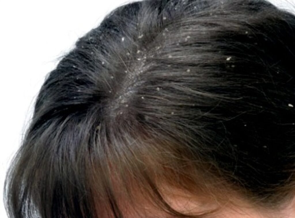 how to remove dandruff without washing hair